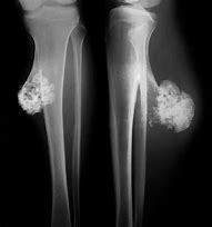 Image result for Exophytic Osteochondroma