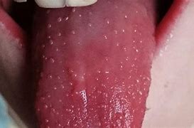 Image result for Hard Spot On Back of Tongue