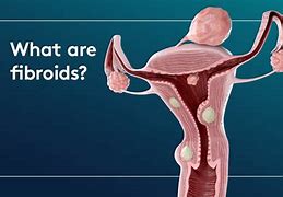 Image result for Fibroid Tumors in Stomach