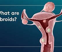 Image result for 5 Cm Fibroid Size