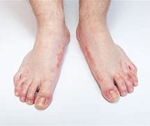 Image result for Rash On Bottom of Feet