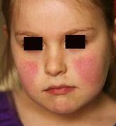 Image result for Allergic Reaction Rash Treatment
