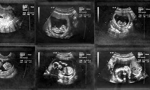 Image result for 1 Week Pregnant Ultrasound