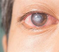 Image result for Contact Lens Eye Infection