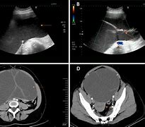 Image result for Giant Ovarian Cyst