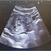 Image result for Necrotic Fibroid Ultrasound