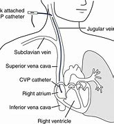 Image result for Central Venous Pressure Catheter
