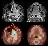 Image result for Nasopharyngeal Cancer Staging