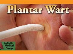 Image result for Plantar Wart Remover