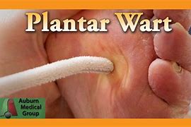 Image result for Plantar Wart Healing Process