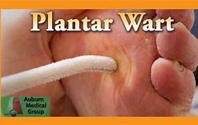 Image result for Planters Warts Treatments