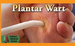 Image result for Plantar Wart Medicine