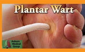 Image result for Dying Plantar Wart