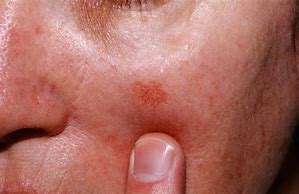 Image result for Actinic Keratosis Chest