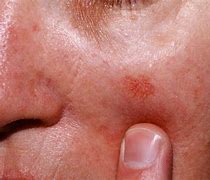 Image result for Keratosis Types