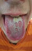 Image result for Chlamydia White Tongue