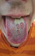Image result for Syphilis Warts