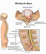 Image result for herniario