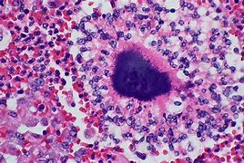 Image result for actinomicosis