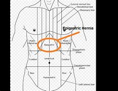 Image result for Epigastric Hernia Symptoms in Men