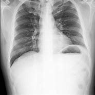 Image result for Nodules On Lungs