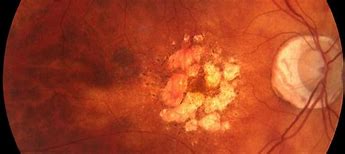 Image result for Stage 4 Macular Hole