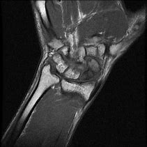 Image result for Scaphoid Fracture Avascular Necrosis