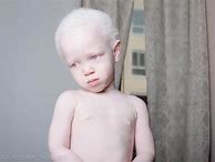 Image result for Albino People ARTOC
