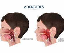 Image result for adenoifes