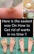 Image result for How to Get Rid of Foot Warts