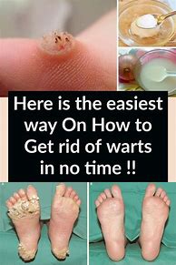 Image result for How to Get Rid of Warts On Ankle Naturally