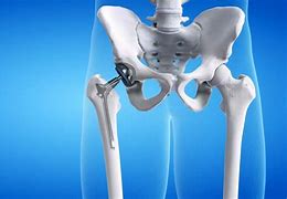 Image result for Hip Surgery Recovery