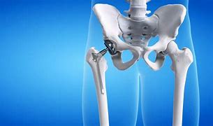 Image result for Recovery Time for Left Hip Surgery