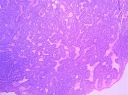 Image result for Papilloma Tumor