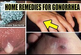 Image result for Person with Gonorrhea