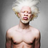 Image result for Albino People