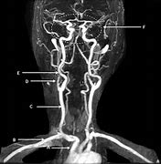 Image result for Bulging Carotid Artery in Neck