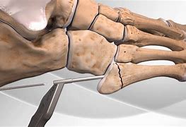 Image result for Jones Fracture Foot Surgery
