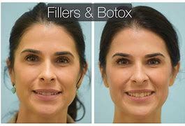 Image result for How Old Start Botox