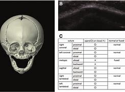 Image result for Craniosynostosis Ultrasound