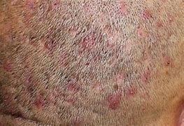 Image result for Folliculitis On Head