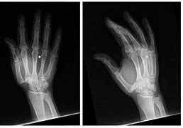 Image result for Sprained Thumb