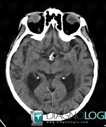 Image result for Dermoid Cyst CT