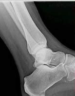 Image result for OS Peroneum Fracture