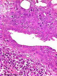 Image result for 2 Cm Tumor