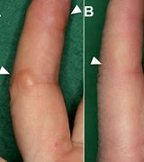 Image result for Rheumatoid Nodules Under Skin