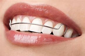 Image result for Retainer Fitting