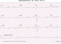 Image result for Anteroseptal MI ECG