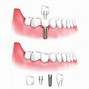 Image result for Implant Dental Clip Art