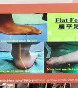 Image result for Flat Foot vs Normal Foot